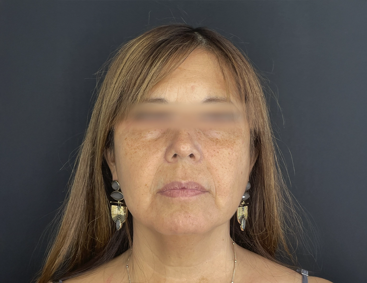 ANTES_Y_DSP_ENDOLIFT_1