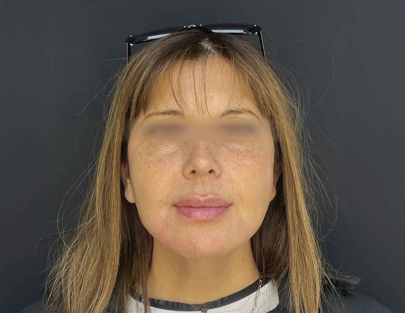 ANTES_Y_DSP_ENDOLIFT_2